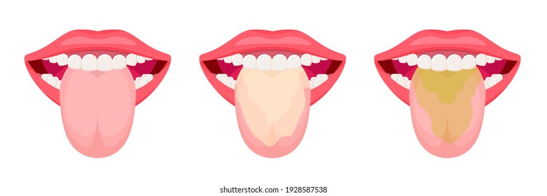 Tongues with a coating and clean. Oral hygiene. Vector illustration isolated on white background