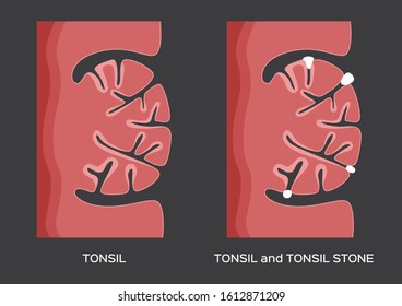 tonsil stone in the mouth vector