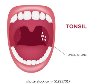 tonsil stone in the mouth vector