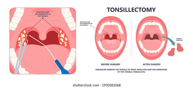 6 Best Homeopathic Medicines for Tonsillitis Treatment