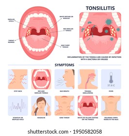 Tonsil Stones crypts viral virus gland strep throat sore enlarged lymph nodes neck pain swollen pus white mouth bacteria Herpes simplex HSV cold fever Epstein Barr fetid bad odor oral laser aureus