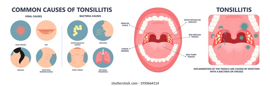 Tonsil Stones Crypts Viral Virus Gland Strep Throat Sore Enlarged Lymph Nodes Neck Pain Swollen Pus White Mouth Bacteria Herpes Simplex HSV Cold Fever Epstein Barr Fetid Bad Odor Oral Laser Aureus