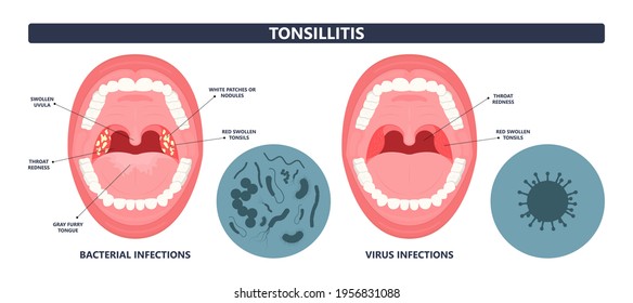 Tonsil Stones Crypts Viral Virus Gland Strep Throat Sore Enlarged Lymph Nodes Neck Pain Swollen Pus White Mouth Bacteria Herpes Simplex HSV Cold Fever Epstein Barr Fetid Bad Odor Oral Laser Aureus