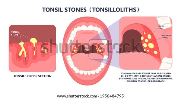 Vektor Stok Tonsil Stones Crypts Viral Virus Gland Tanpa Royalti 1950484795