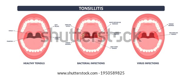 Tonsil Stones Crypts Viral Virus Gland Stock-vektor (royaltyfri) 1950589825