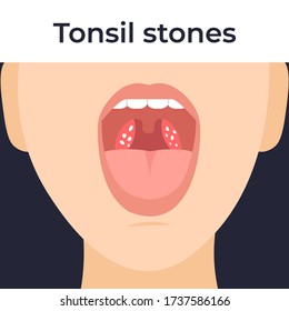 Tonsil stones in the throat, tonsilloliths. Flat vector cartoon illustration.