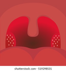 Tonsilitis, sore throat vector illustration