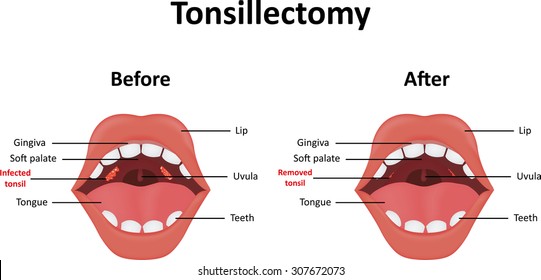 Tonsillectomy Stock Vector (Royalty Free) 307672073 | Shutterstock