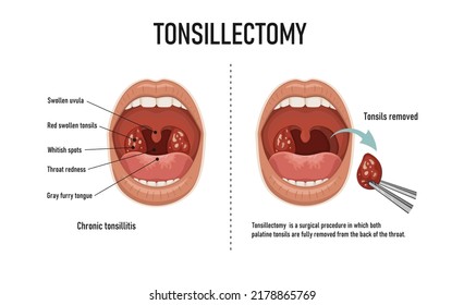 Tonsillectomy. Removal of palatine tonsils. Acute pharyngitis
