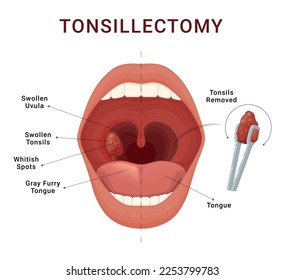 Tonsillectomy scheme removal of palatine tonsils acute pharyngitis vector isometric illustration. Open human mouth inflammation bacterial disease adenoids infection breath blockage medical infographic