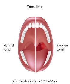 Tonsil bengkak