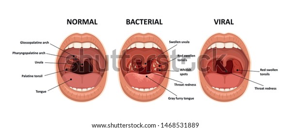Tonsillitis bacterial and viral.\
Angina, pharyngitis and tonsillitis. Infection of tonsils. Open\
mouth