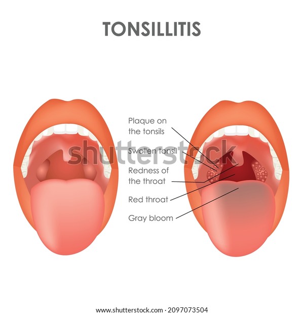 Tonsillitis Norm Disease Throat Structure Vector Stock Vector (Royalty ...