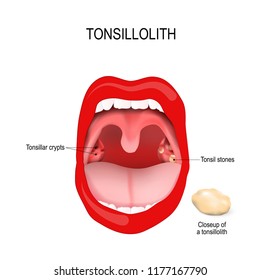 tonsillolith lodged in the tonsillar crypt. close-up of the tonsil stones. Human mouth. Vector diagram for medical and educational use