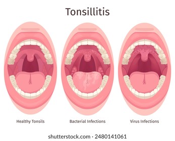 Tonsils. Human sore throat airways inflammation tonsil lymph and tongue in open mouth, bacteria swollen glands pharyngitis tonsillolith disease symptom, swanky vector illustration