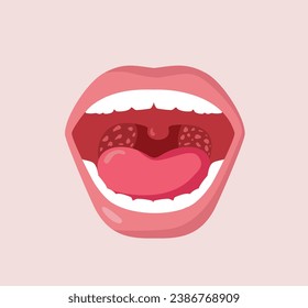 
Tonsils inflammation Vector Concept Image of an Open Mouth
Medical condition of swollen glands and bacterial infections in throat 
