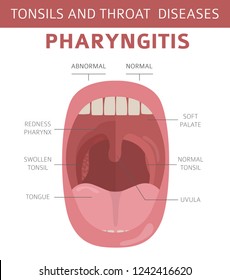 Tonsils and throat diseases. Pharyngitis symptoms, treatment icon set. Medical infographic design. Vector illustration