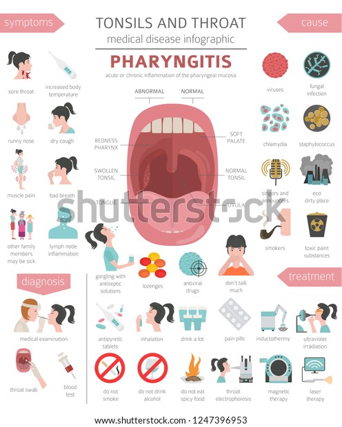 Tonsils Throat Diseases Pharyngitis Symptoms Treatment Stock Vector ...