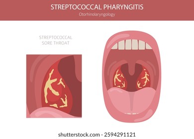 Tonsils and throat diseases. Streptococcal Pharyngitis. Medical infographic design. Vector illustration