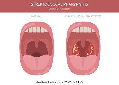 Tonsils and throat diseases. Streptococcal Pharyngitis. Medical infographic design. Vector illustration