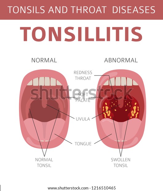 Tonsils Throat Diseases Tonsillitis Symptoms Treatment Stock Vector ...