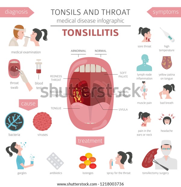 Tonsils Throat Diseases Tonsillitis Symptoms Treatment Stock Vector ...