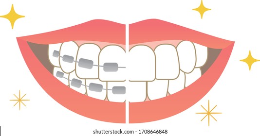 
Tooth alignment Dental care Before orthodontic treatment After treatment