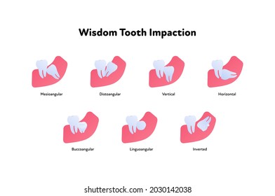 Tooth anatomy chart. Vector biomedical illustration. Cross section. Wisdom teeth impaction set isolated on white background. Design for dental oral healthcare, dentistry