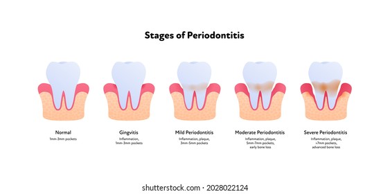 Tooth anatomy and decay chart. Vector biomedical illustration. Side view. Stages of teeth periodontitis illness isolated on white background. Design for healthcare, dentistry