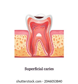 Tooth anatomy with superficial caries realistic vector illustration