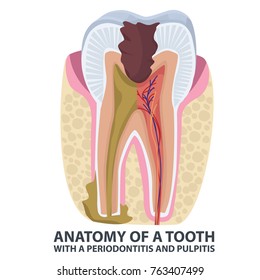 Tooth anatomy vector dental infographics. Enamel and dentin caries, pulpits and periodontitis medical vector illustration Medical banner or poster illustration