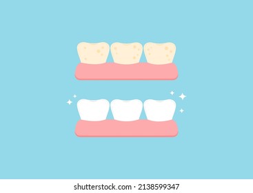 Tooth bleaching health and tooth with yellow plaque before, after icon set. Teeth stain cleaning, whitening concept. Flat design cartoon vector illustration. Dental oral hygiene stained teeth