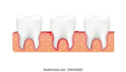 Tooth Is Bleeding In The Gum. Blood Teeth. Vector