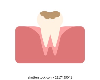 Tooth with caries. Tooth decay. Bad tooth. Dental care background. Unhealthy teeth. Vector illustration flat design. Isolated on background. Stomatology care for teeth