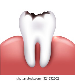 Tooth with caries, tooth decay. White background