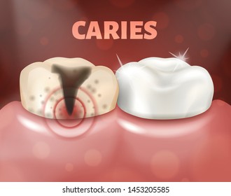 Tooth with caries and healthy tooth. 3d realistic vector illustration of dental disease. Deep caries on a sick tooth
