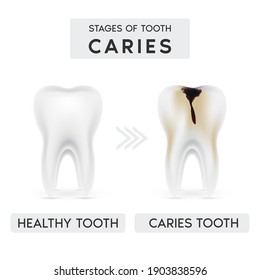 Tooth caries structure and Progression and Treatment: Dental Illustration. In realistic style. Stain, enamel caries, dentil, pulpitis, periodontitis. Vector illustration 3d.