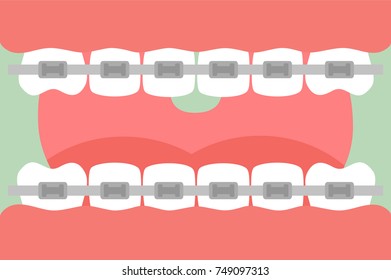 tooth cartoon vector flat style for design - orthodontics teeth or dental braces, open mouth with healthy teeth and tongue