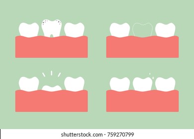 tooth cartoon vector flat style for design - step of caries to first teeth, dental care concept