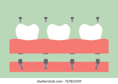 tooth cartoon vector flat style for design - dental prostheses, filling denture on gum