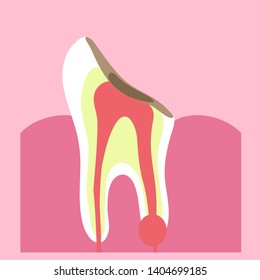 Tooth and chip on the tooth on a pink background. Vector illustration.