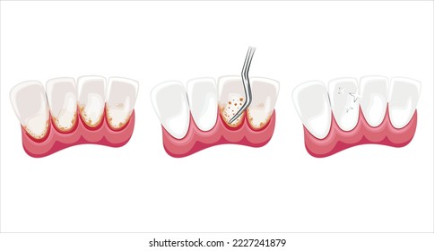 Ilustración de limpieza dental, Dientes sanos, Ilustración del vector dentista, Cuidado oral