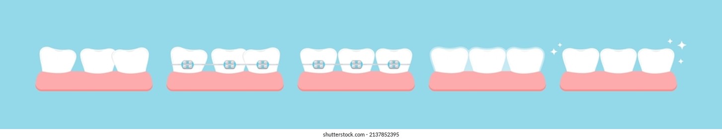 Tooth crooked, with dental braces stage, mouth guard in gym before after icon set. Dental braces on white teeth orthodontic bracket aesthetic correction treatment concept. Vector teeth illustration.