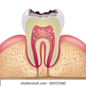 Tooth cross section with dental caries, detailed illustration