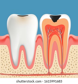 Tooth decay anatomy poster.  Enamel and dentin of teeth caries Infection. Vector illustration