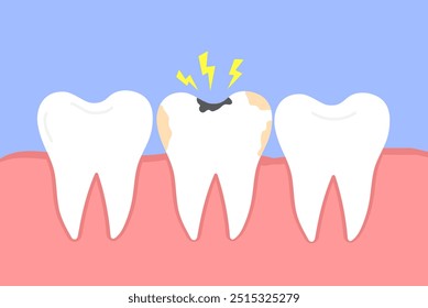 Cárie dentária. Cárie dentária. Dente danificado. Dor molar. Ilustração vetorial