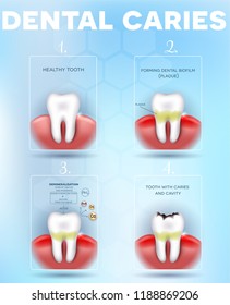 Tooth Decay Dental Caries Formation Detailed Stock Vector (Royalty Free ...