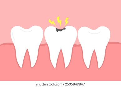 Tooth decay. Dental caries. Toothache molar. Vector illustration