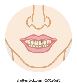 Cárie dentária e dentes sujos