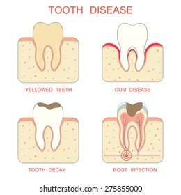 tooth decay disease,periodontal gum, yellowed teeth, root infection
